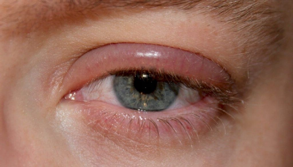eyelash extensions blepharis