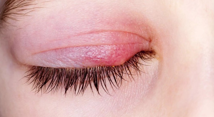 Can you get lash extensions if you have a stye