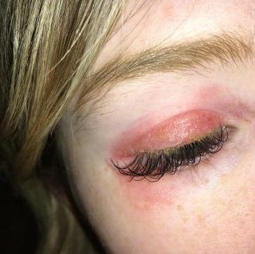 Chemical Burn and eyelash extensions